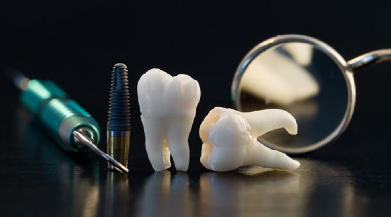 Healing Process Of Tooth Extraction Wound - PANDA ORAL